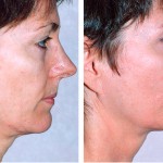 thermage befor and after
