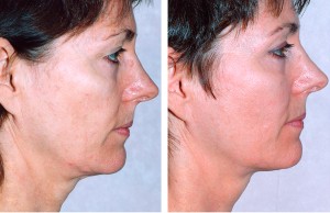 thermage befor and after