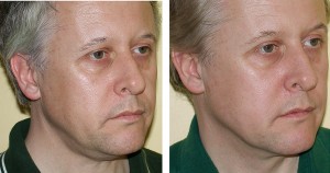 thermage-non-surgical-face-lift