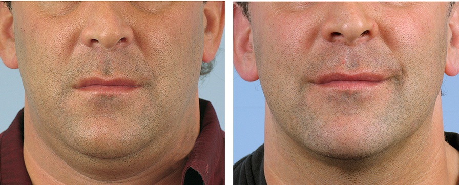 Thermage Man Chin and Neck