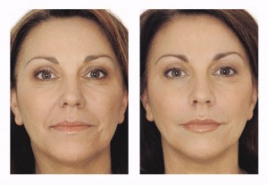 mesotherapy-face-copy1-before