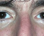 carboxytherapy-eyes-after