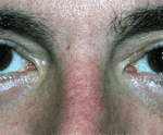 carboxytherapy-eyes-before