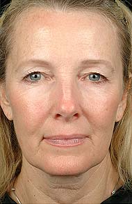 thermage wrinkles -after