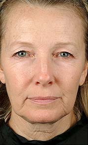 thermage wrinkles-before